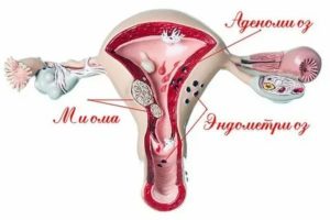 Как эндометриоз влияет на зачатие ребенка у женщин