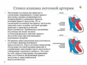 Что такое клапанный стеноз легочной артерии у плода