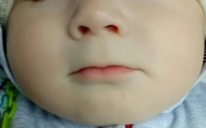 Почему у грудного ребенка синеет верхняя губа