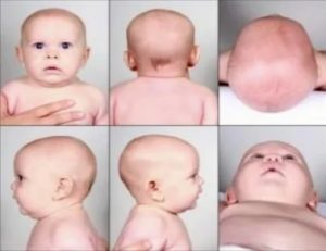 Что делать когда у грудного ребенка кривая голова