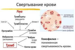 Что делать если свертываемость плохая у новорожденного