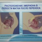 Диета при тромбофилии при планировании беременности