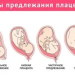 Как спайки могут влиять на зачатие