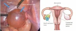 Можно ли беременеть при кисте яичника желтого тела