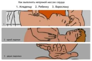 Как делать массаж сердца и искусственное дыхание новорожденным